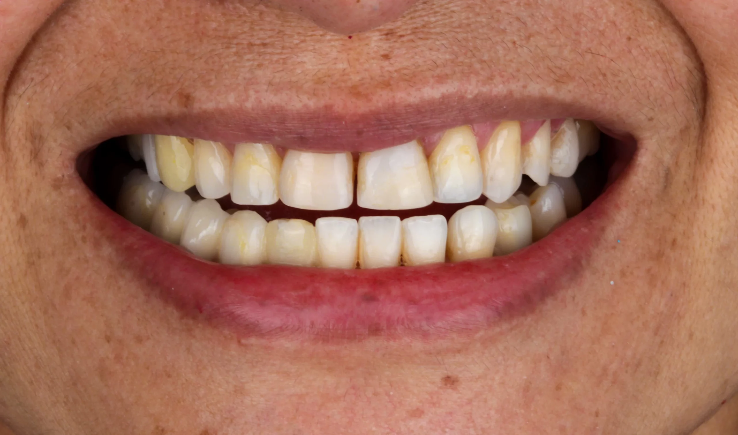 Diseño Sonrisa Ceramica FAME Studio antes