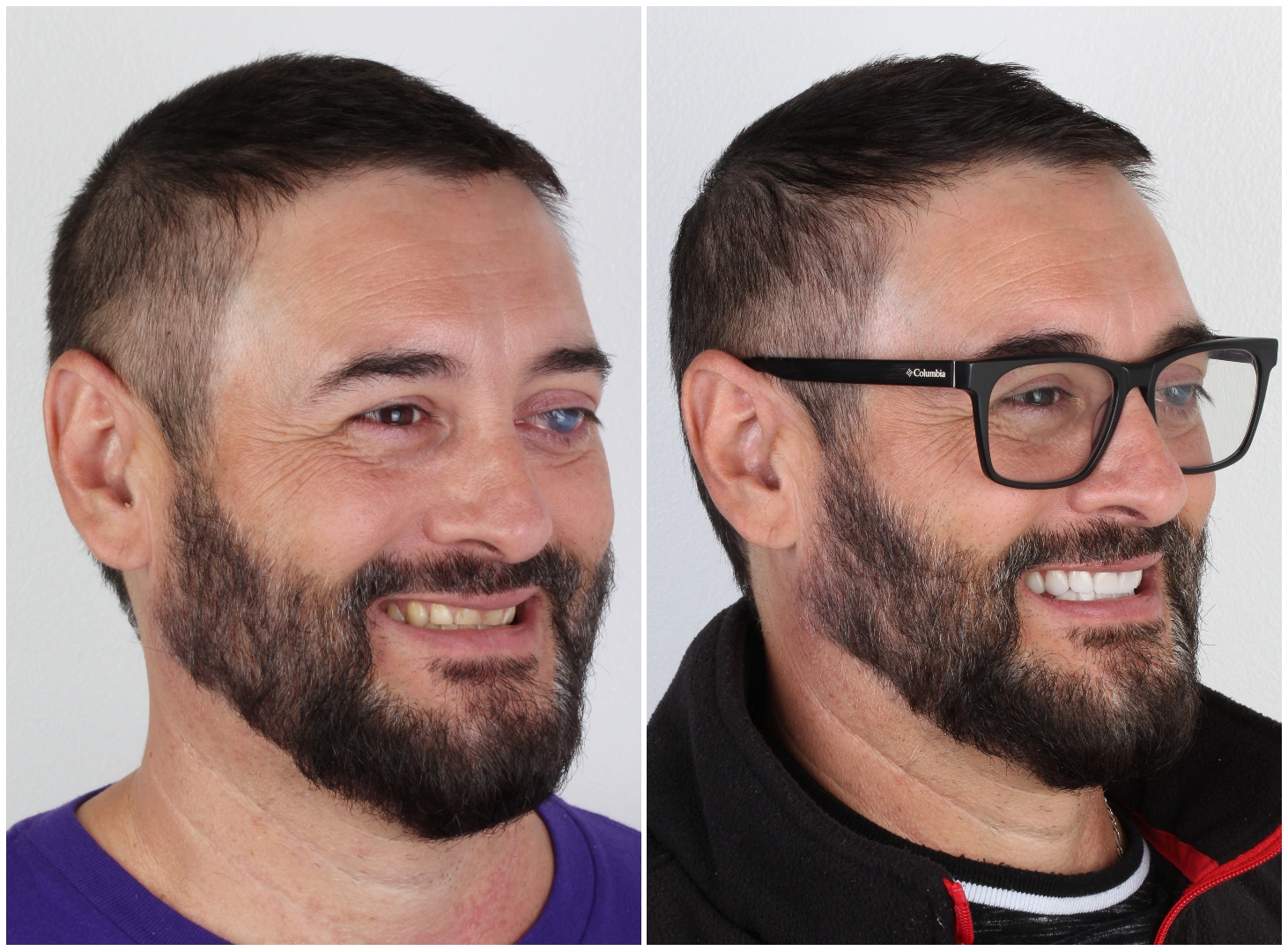 How Much Does A Smile Design Cost In Colombia Fame Dental Studio How Much Does A Smile Design Cost In Colombia Fame Dental Studio