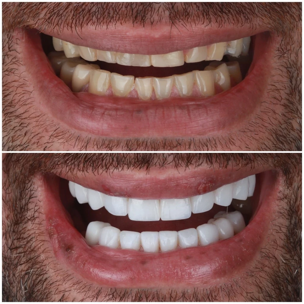 Diseño de Sonrisa Carillas Ceramicas Fame Dental Studio