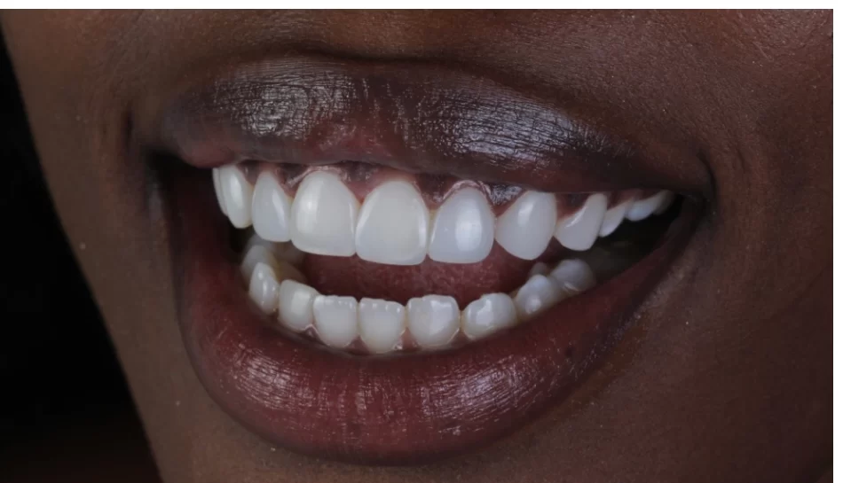 Errores comunes después de un diseño de sonrisa y cómo evitarlos