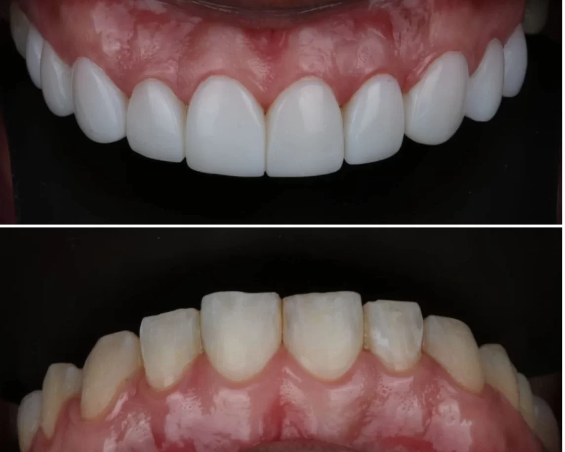 5 factores que determinan el éxito de tu diseño de sonrisa