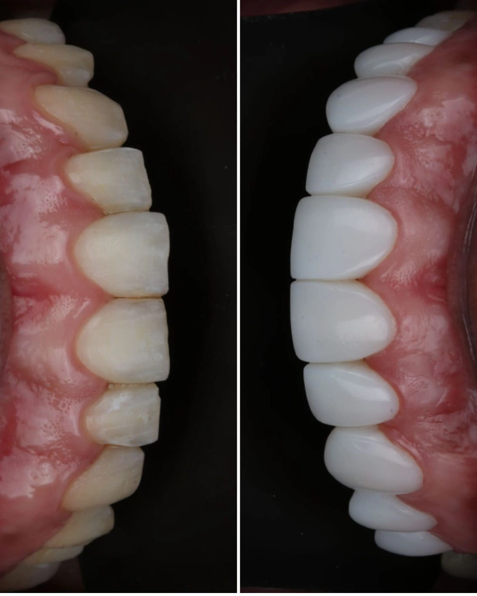 5 factores que determinan el éxito de tu diseño de sonrisa