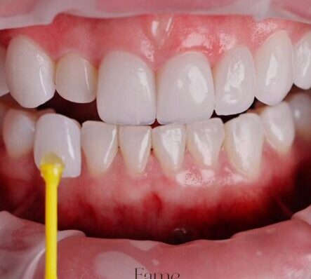 ¿Las carillas dañan los dientes? Mitos vs realidad