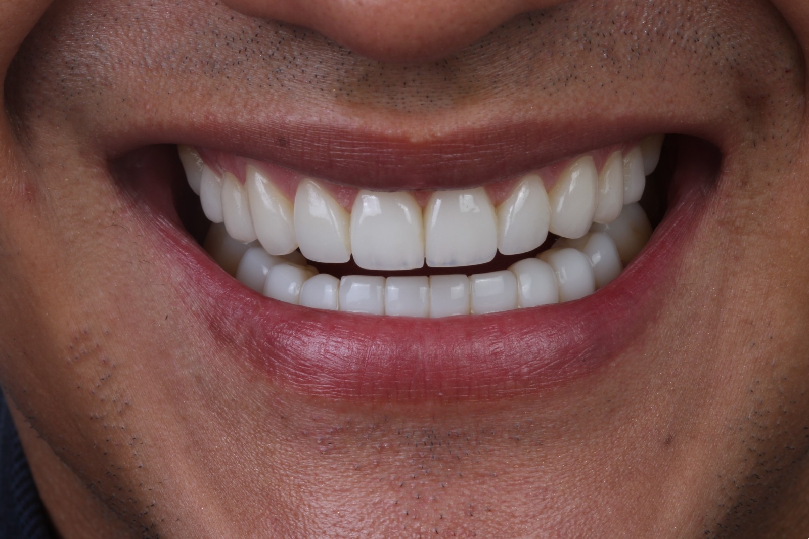 ¿Qué incluye un tratamiento de rehabilitación oral integral?