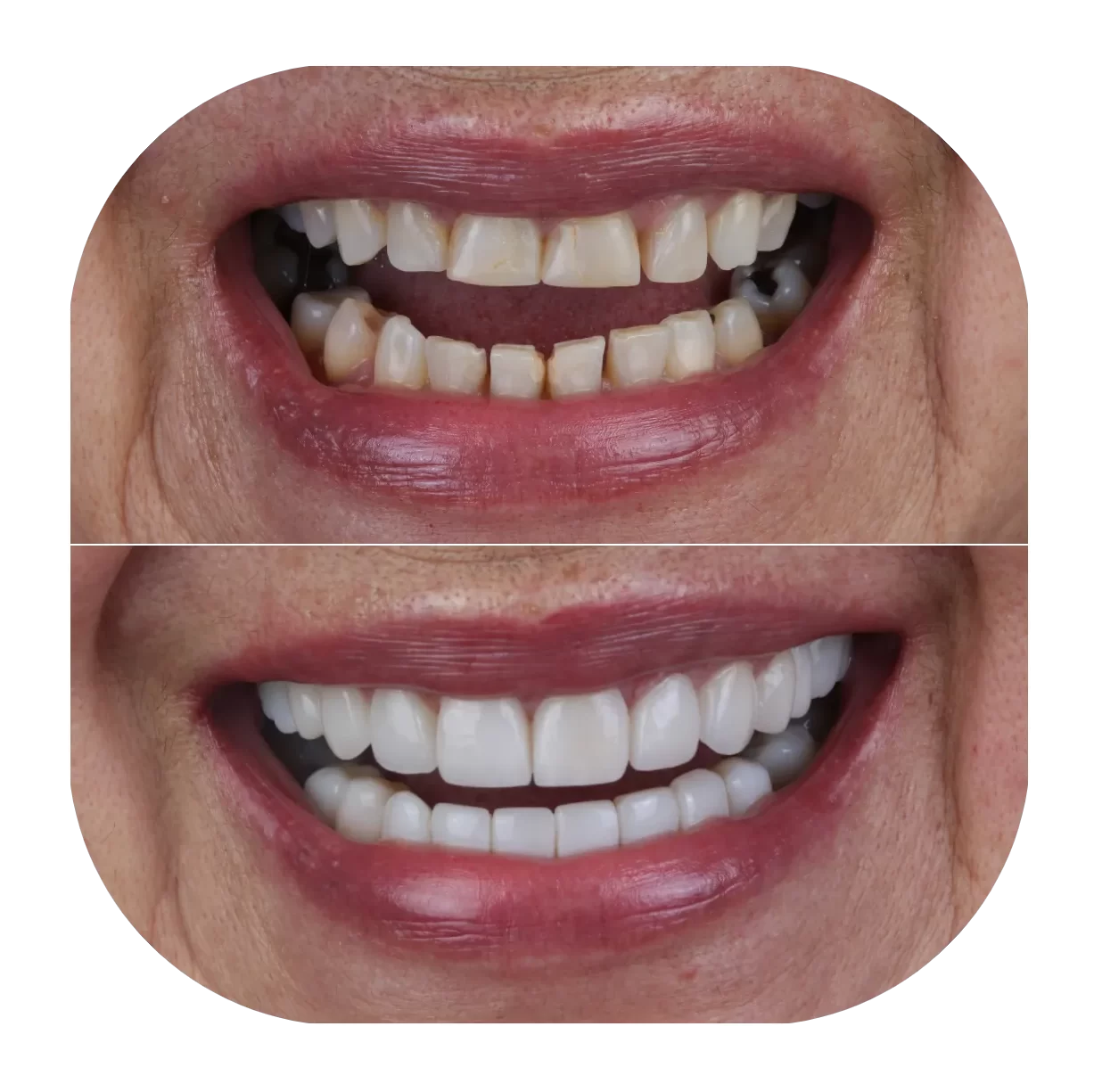 ¿Vale la pena el precio de las carillas dentales? Te lo contamos